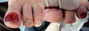 pinpointe foot laser before and after 1
