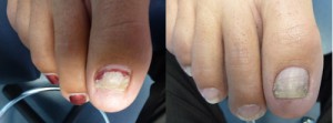 pinpointe footlaser before and after 2
