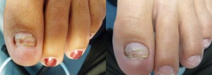 pinpointe footlaser before and after 3